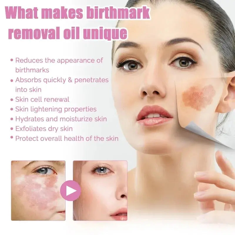 Skin Birthmark removal Serum Anti Freckle fade Pigmentation Melasma MoSPECIFICATIONSFeature: WhiteningGender: UnisexlItem Type: Face SerumFunction: Whitening, moisturizing, lightening spots, shrinking poresEffect: Anti-freckle and whitJohnny TirakJohnny TirakSkin Birthmark removal Serum Anti Freckle fade Pigmentation Melasma Moisturizing Whitening Brighten Face Care Essence Oil