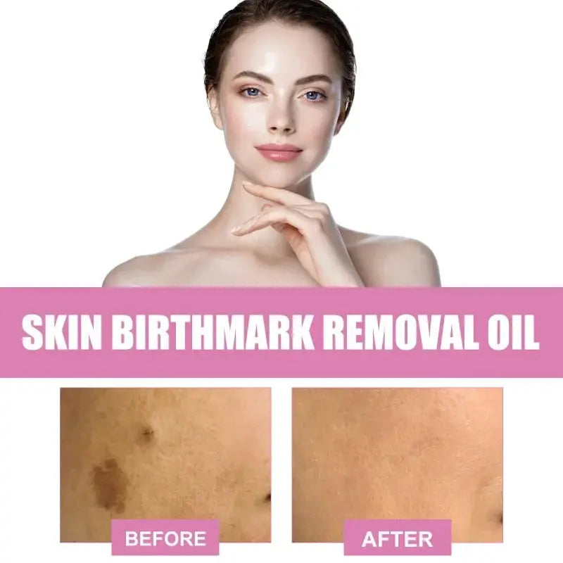 Skin Birthmark removal Serum Anti Freckle fade Pigmentation Melasma MoSPECIFICATIONSFeature: WhiteningGender: UnisexlItem Type: Face SerumFunction: Whitening, moisturizing, lightening spots, shrinking poresEffect: Anti-freckle and whitJohnny TirakJohnny TirakSkin Birthmark removal Serum Anti Freckle fade Pigmentation Melasma Moisturizing Whitening Brighten Face Care Essence Oil