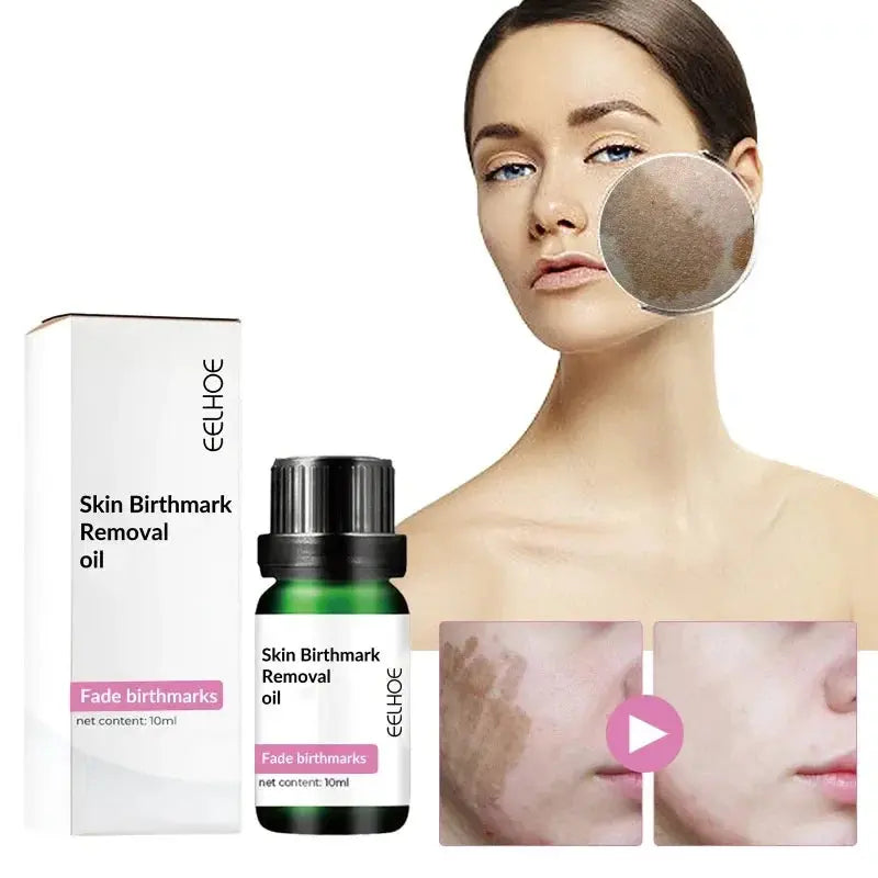 Skin Birthmark removal Serum Anti Freckle fade Pigmentation Melasma MoSPECIFICATIONSFeature: WhiteningGender: UnisexlItem Type: Face SerumFunction: Whitening, moisturizing, lightening spots, shrinking poresEffect: Anti-freckle and whitJohnny TirakJohnny TirakSkin Birthmark removal Serum Anti Freckle fade Pigmentation Melasma Moisturizing Whitening Brighten Face Care Essence Oil