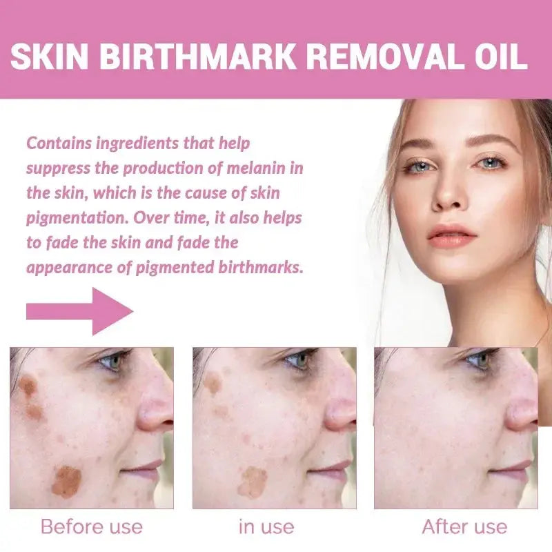 Skin Birthmark removal Serum Anti Freckle fade Pigmentation Melasma MoSPECIFICATIONSFeature: WhiteningGender: UnisexlItem Type: Face SerumFunction: Whitening, moisturizing, lightening spots, shrinking poresEffect: Anti-freckle and whitJohnny TirakJohnny TirakSkin Birthmark removal Serum Anti Freckle fade Pigmentation Melasma Moisturizing Whitening Brighten Face Care Essence Oil